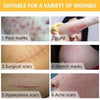 Home Laser Removal Pen for Tattoos Moles & Blemishes