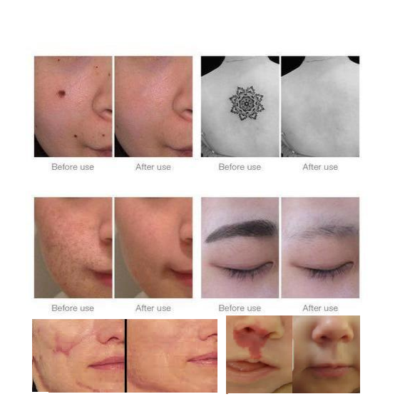 Home Laser Removal Pen for Tattoos Moles & Blemishes